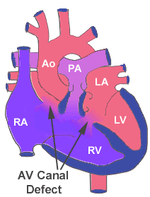  Komplet atrioventriküler septal defekt