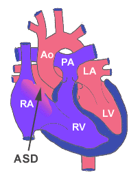  Atrial septal defekt