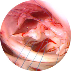 Komplet atrioventriküler septal defekt