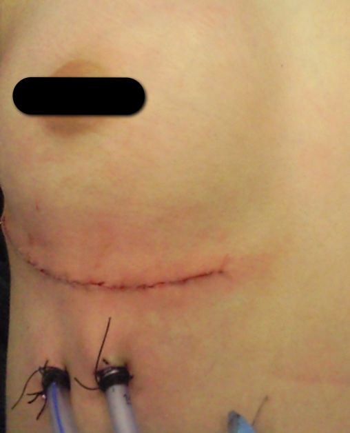  submammarian incision