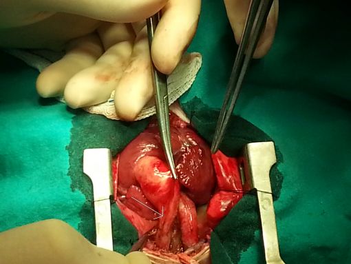   Interrupted aortic arch type C variant