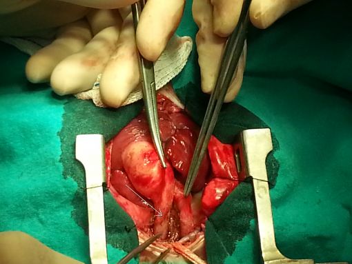   Interrupted aortic arch type C variant