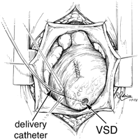  Periventricular VSD closure