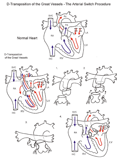  Arterial switch procedure