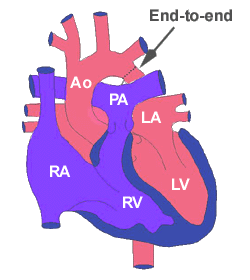  End-to-end anastomoz