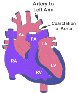  Aort koarktasyonu