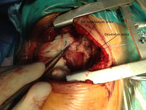  Double Arkus Aorta ameliyatı