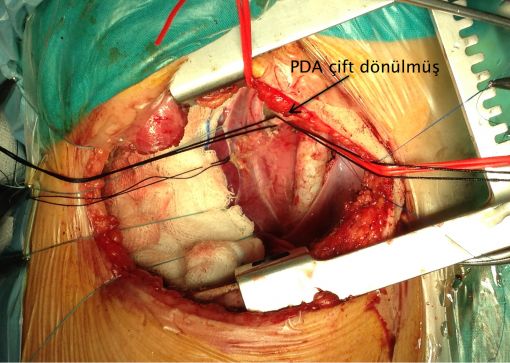  Double Arkus Aorta ameliyatı