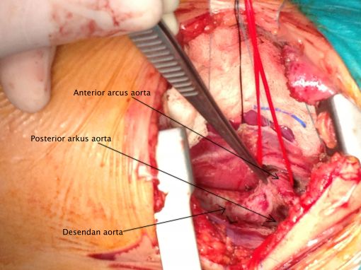  Double Arkus Aorta ameliyatı