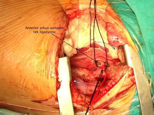  Double Arkus Aorta ameliyatı