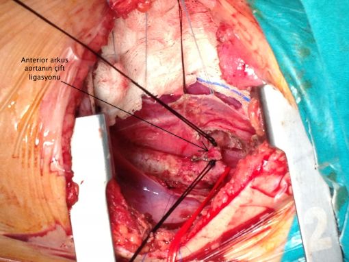  Double Arkus Aorta ameliyatı