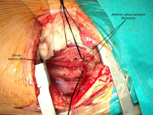  Double Arkus Aorta ameliyatı