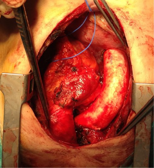  Extracardiac Fontan Operation