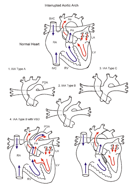  Interrupted aortik ark