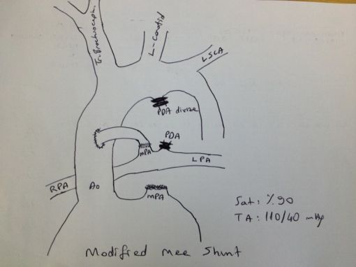  Modified Mee Shunt