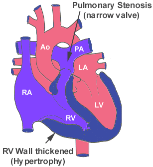  Pulmoner stenoz