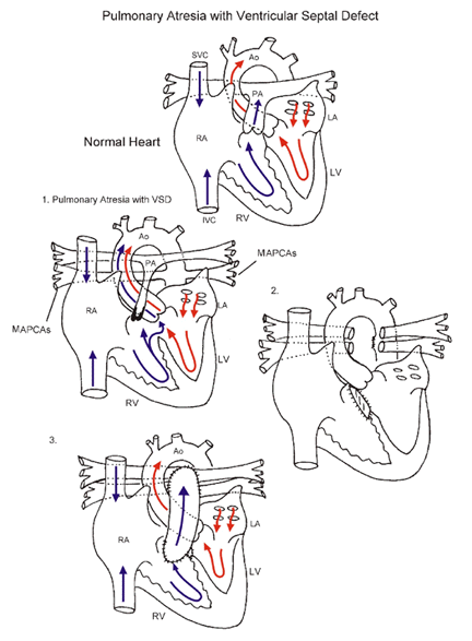  VSD-PA