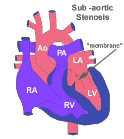Subaortik stenoz