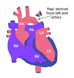  Subklavian flap tekniği