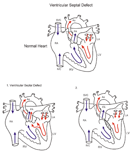 VSD