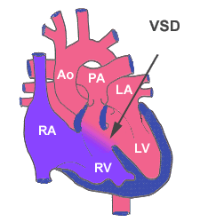 VSD